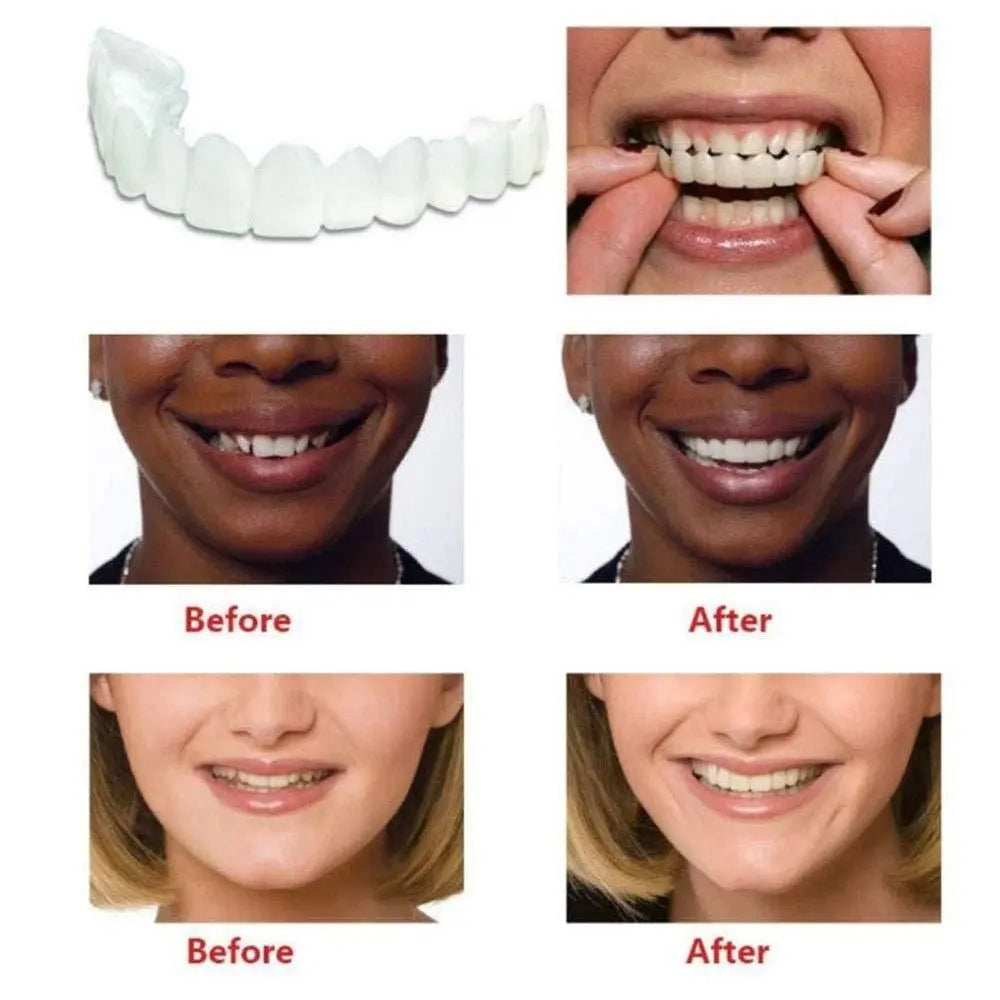 PerfectSmile Pro- Tijdelijke tanden Venner en prothese | 1+1 GRATIS